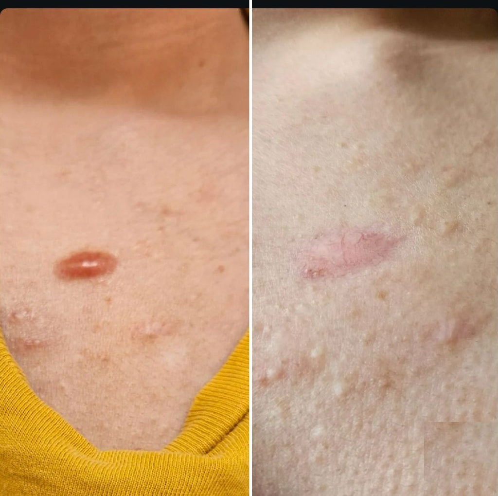 100% Medical Grade Silicone Scar Gel