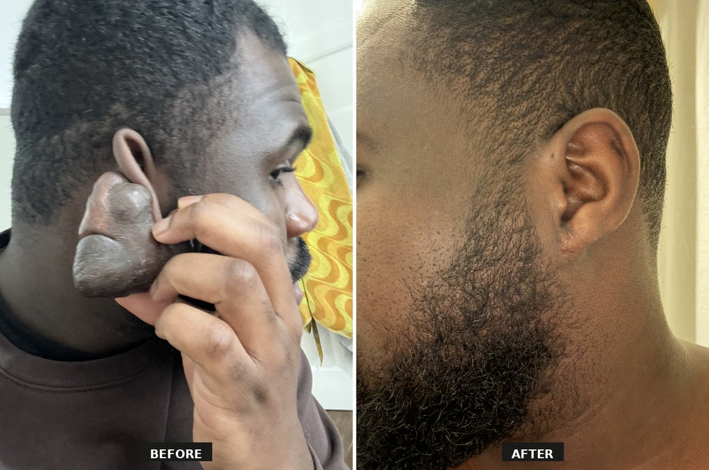 100% Medical Grade Silicone Scar Gel