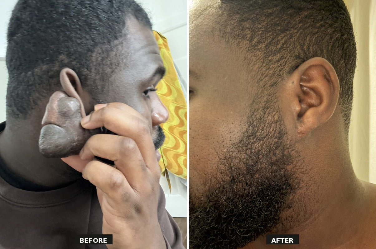 100% Medical Grade Silicone Scar Gel